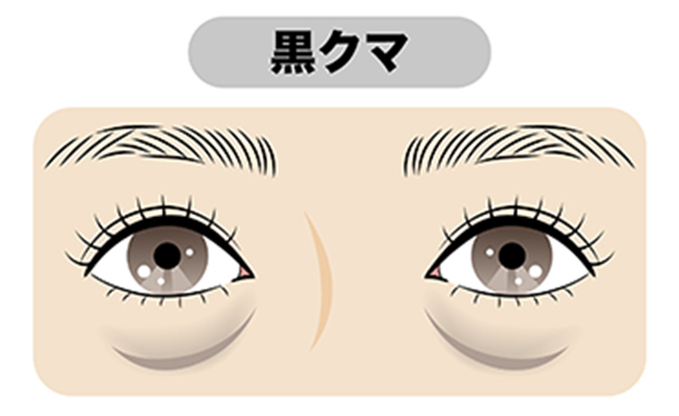 肌のハリの低下によって生じる黒クマのイラスト