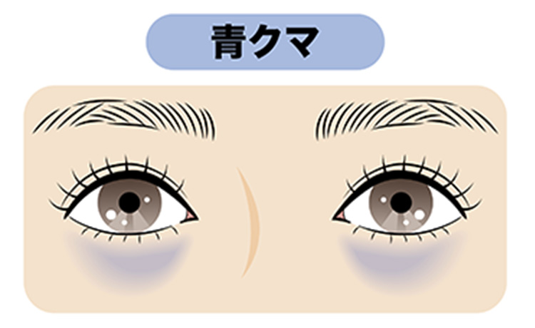 目元の血行不良によって生じる青クマのイラスト