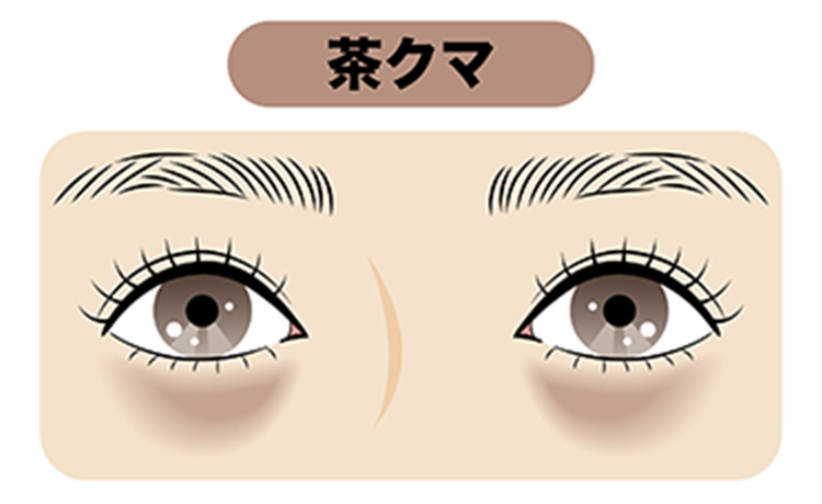 色素沈着によって生じる茶クマのイラスト