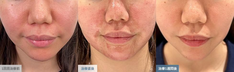 ダーマペン治療で肌質が改善した様子