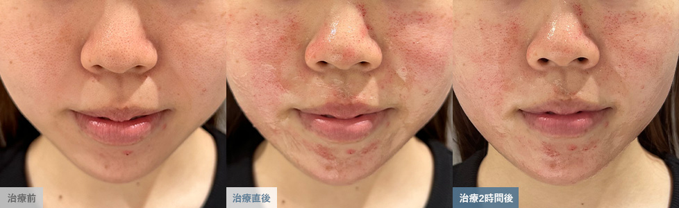 ダーマペン治療で点状出血が生じた肌