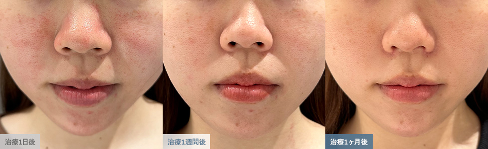 ダーマペン治療による点状出血が改善した肌