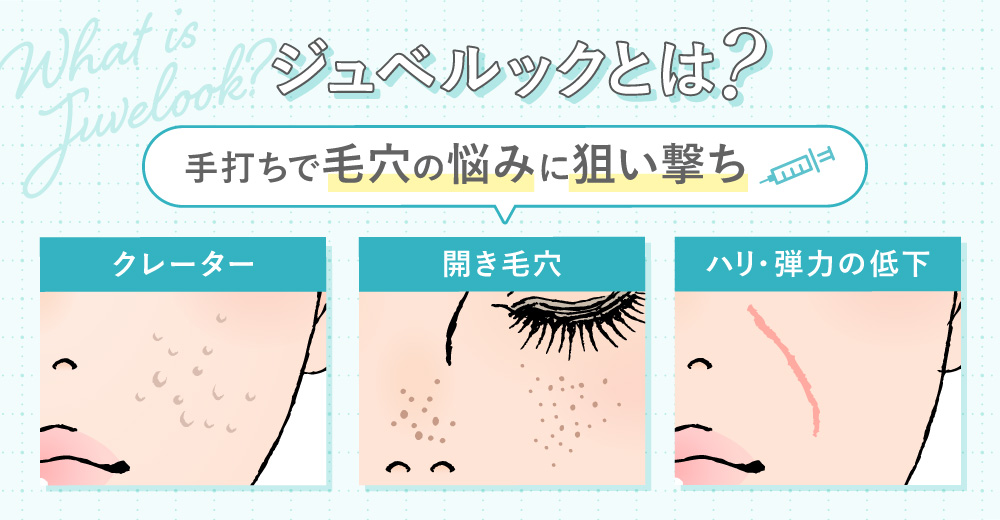 ジュベルックとは