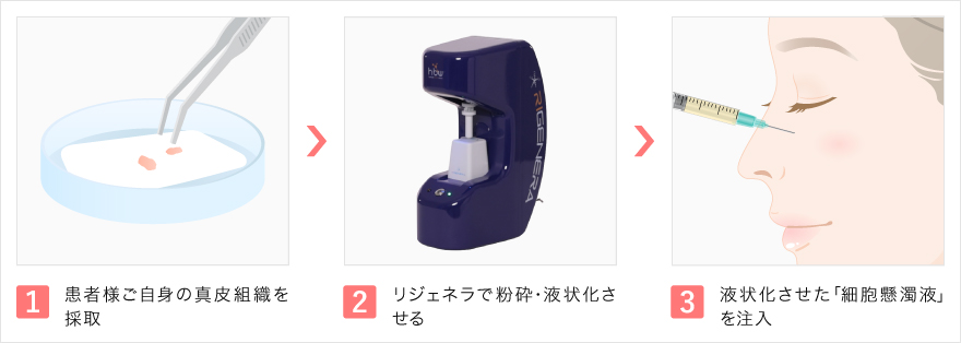 リジェネラの治療の流れ