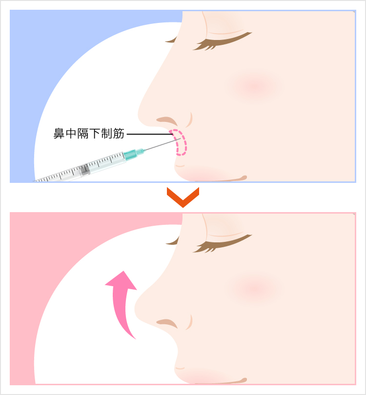鼻中隔下制筋にボトックス注射をして鼻が上向きになるイメージ