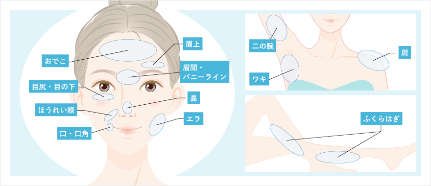 ボトックスの対応部位