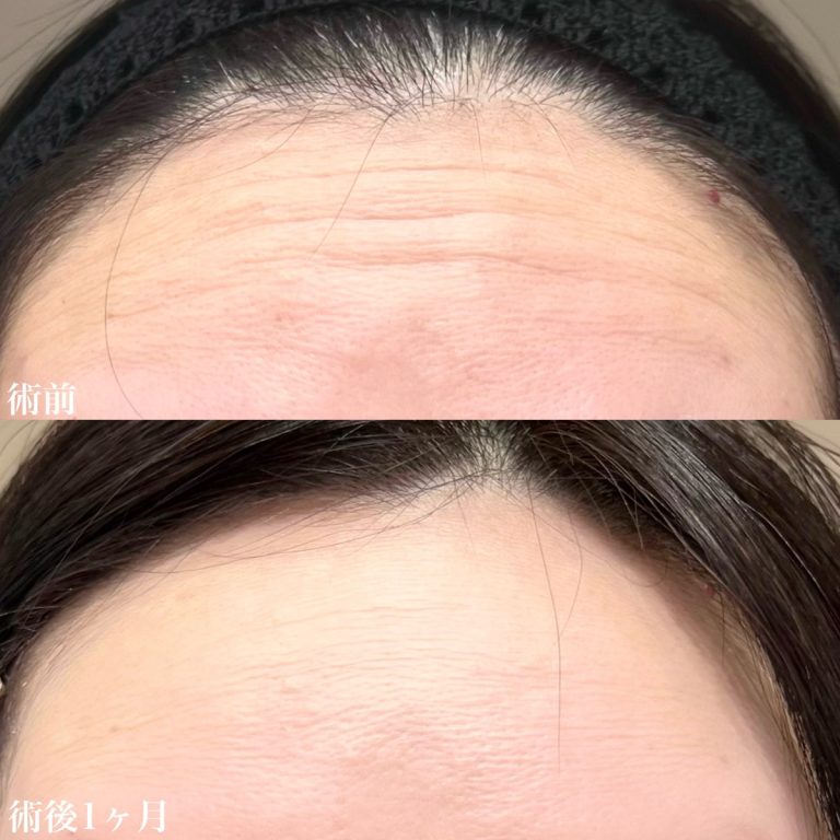 ボトックス注射によって薄くなったおでこのしわ01