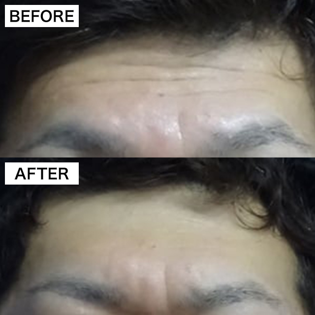 ボトックス注射によって薄くなったおでこのしわ02