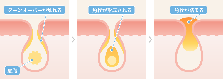 角栓ができる主な原因