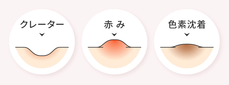 ニキビ跡の種類（クレーター・赤み・色素沈着）