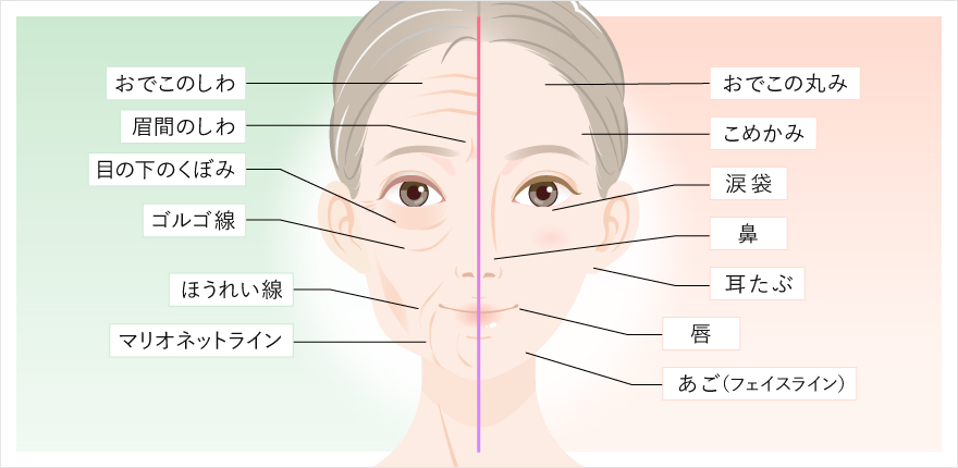 ヒアルロン酸注入の適応部位を解説したイラスト