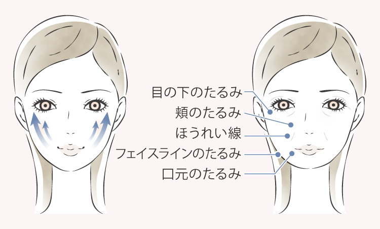 たるみとは