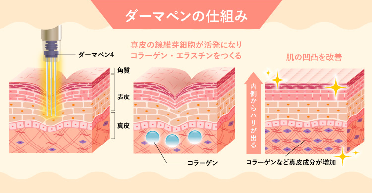 ダーマペン4の仕組み