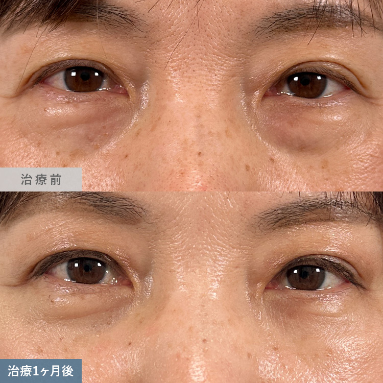 目の下の切らないクマ取り・たるみ取りによる治療前後の画像2