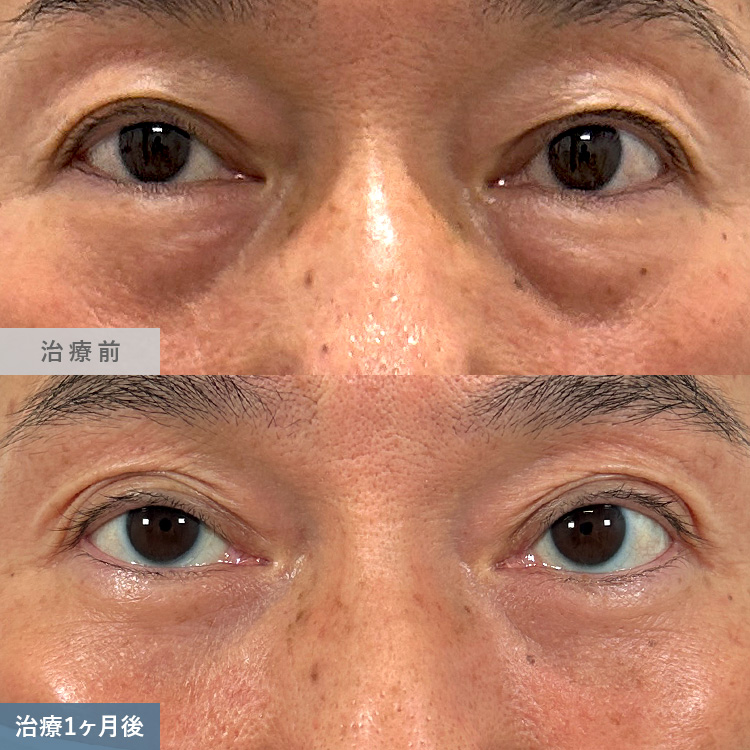 目の下の切らないクマ取り・たるみ取りによる治療前後の画像4