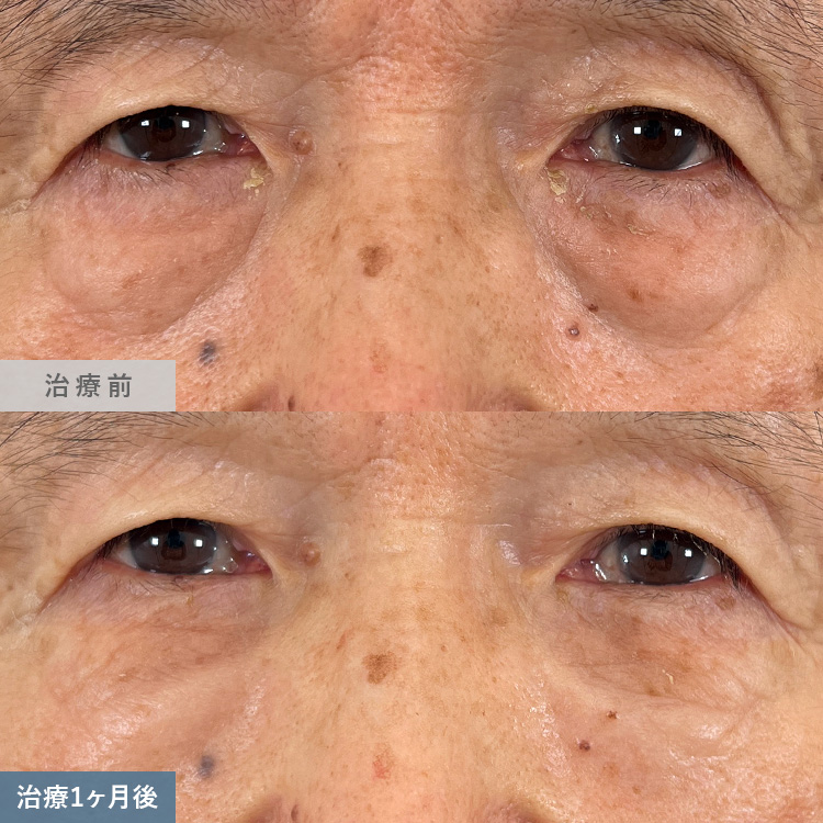 目の下の切らないクマ取り・たるみ取りによる治療前後の画像7