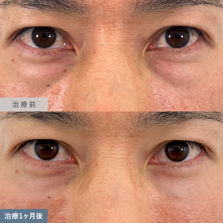 目の下の切らないクマ取り・たるみ取りによる治療前後の画像8