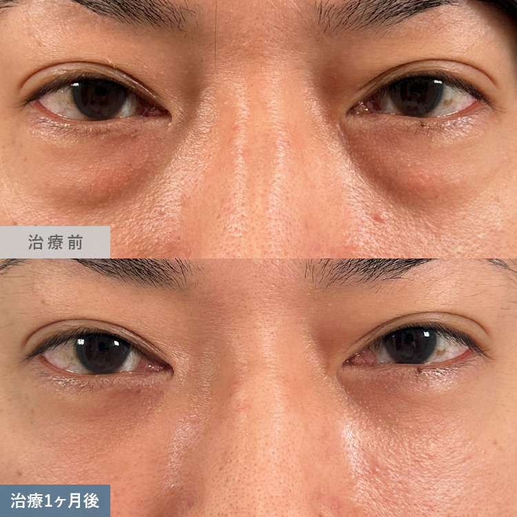 目の下の切らないクマ取り・たるみ取りによる治療前後の画像9