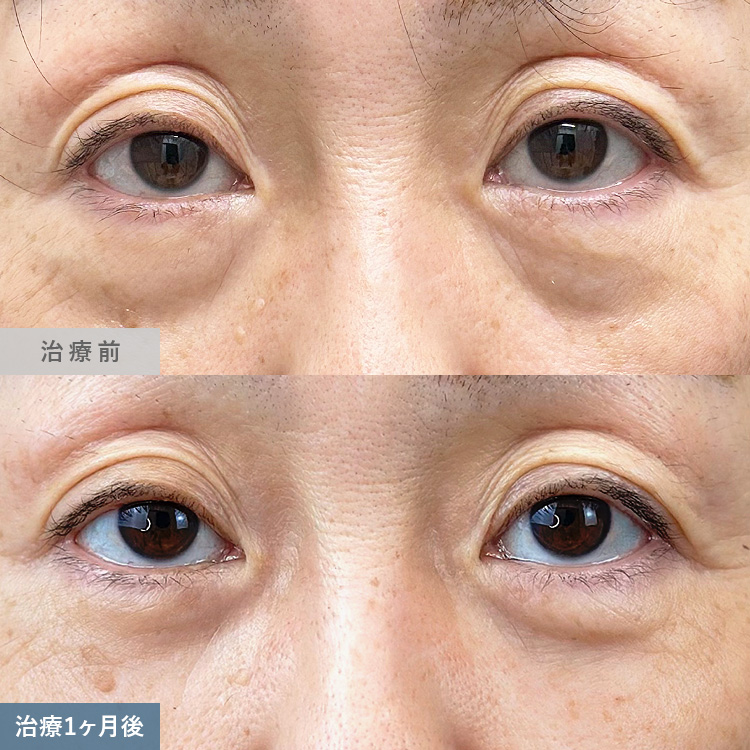 目の下の切らないクマ取り・たるみ取りによる治療前後の画像10