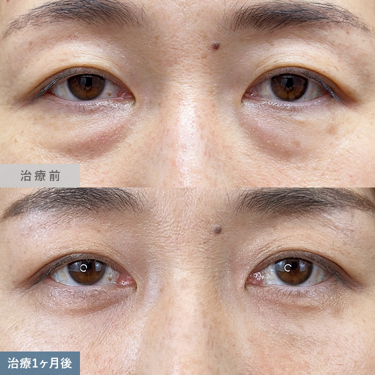 目の下の切らないクマ取り・たるみ取りによる治療前後の画像11