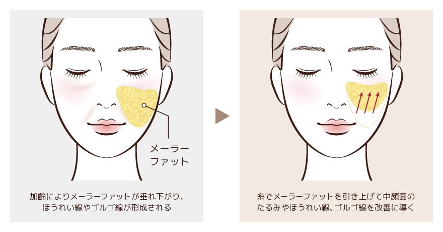 ミッドフェイスリフトのイメージ