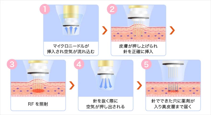 ドラッグデリバリーシステムで薬剤が真皮層まで浸透