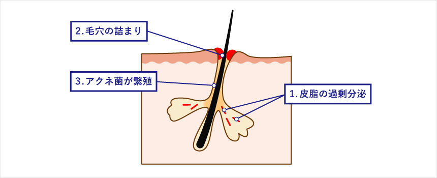 ニキビができる原因