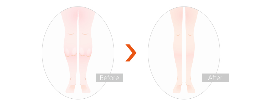 ボトックス注射によって筋肉質なふくらはぎを改善するイラスト