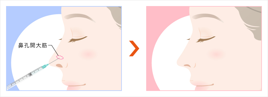 ボトックス注射によって小鼻の広がりを改善するイラスト