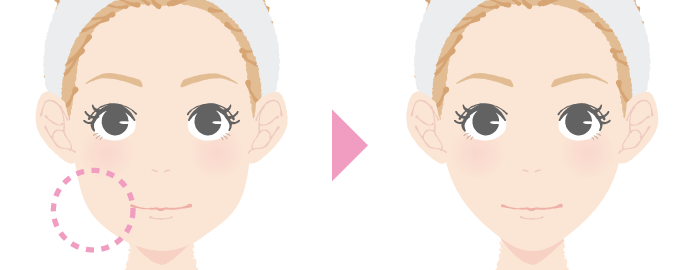 ボトックス注射によってエラ張りを改善するイラスト