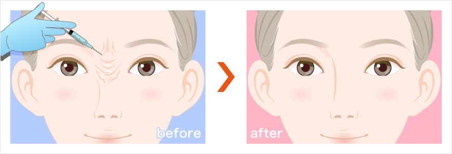 ボトックス注射によって眉間のしわを改善するイラスト
