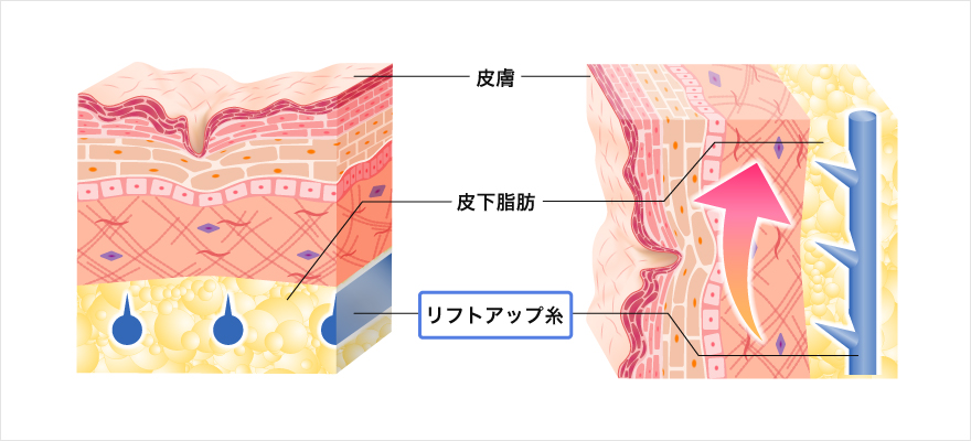 溶ける糸のイメージ