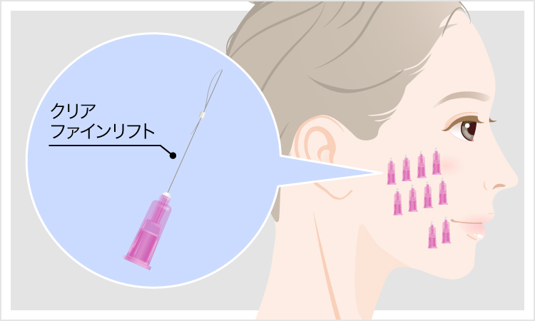クリアファインリフトのイメージ画像