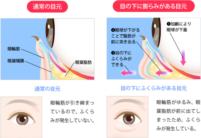 目の下のクマ・目の下のたるみ（ふくらみ）の原因