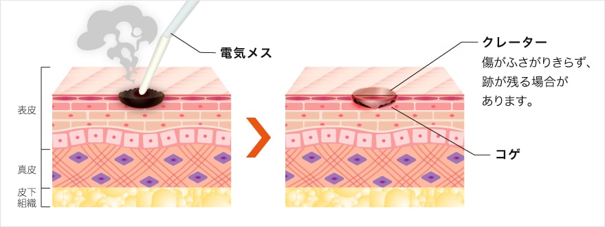 電気メスによる表面分解法