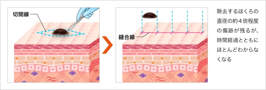 切開法