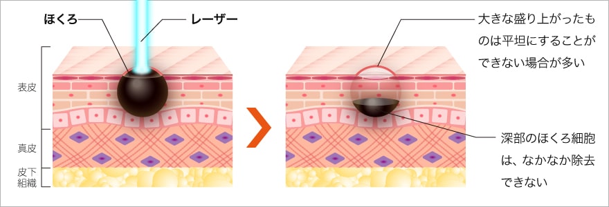 レーザー治療