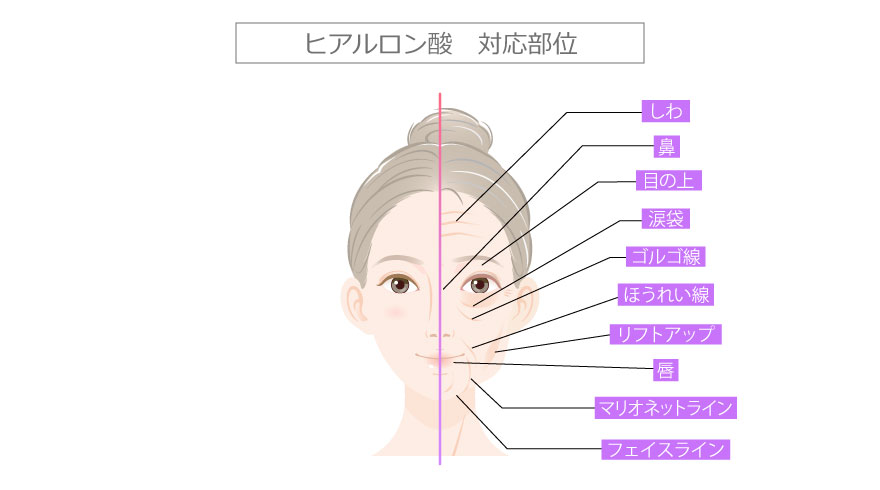 ヒアルロン酸の対応部位