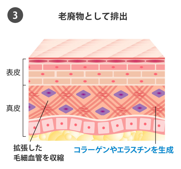 IPL光治療の効果3