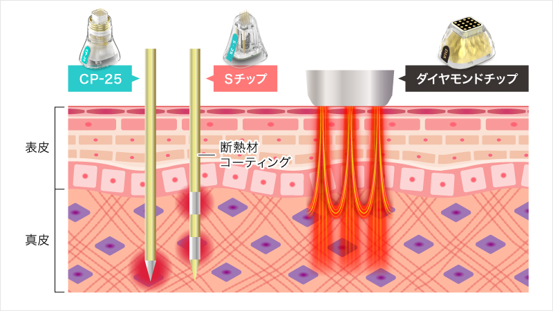 ダウンタイムや痛みを抑える