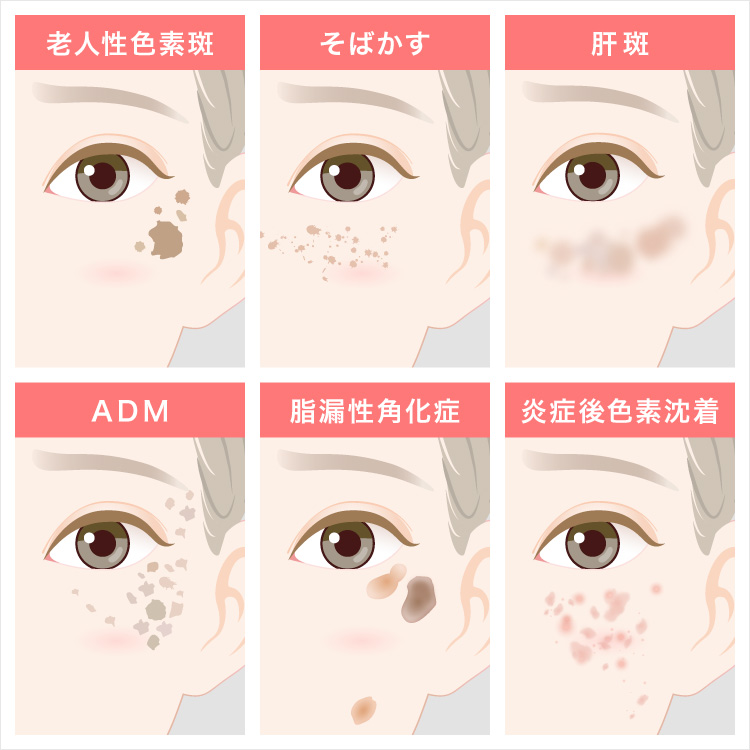 シミの種類