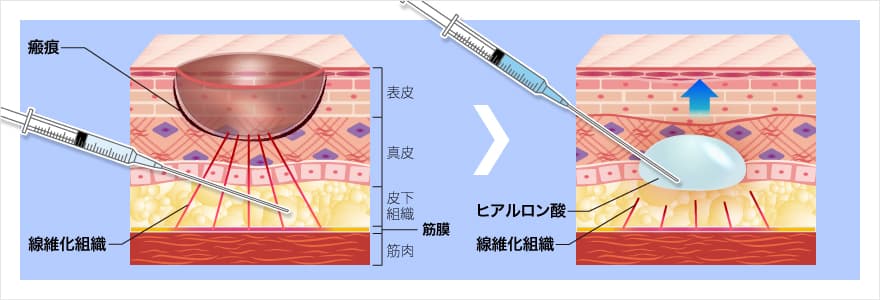 サブシジョン＋ヒアルロン酸