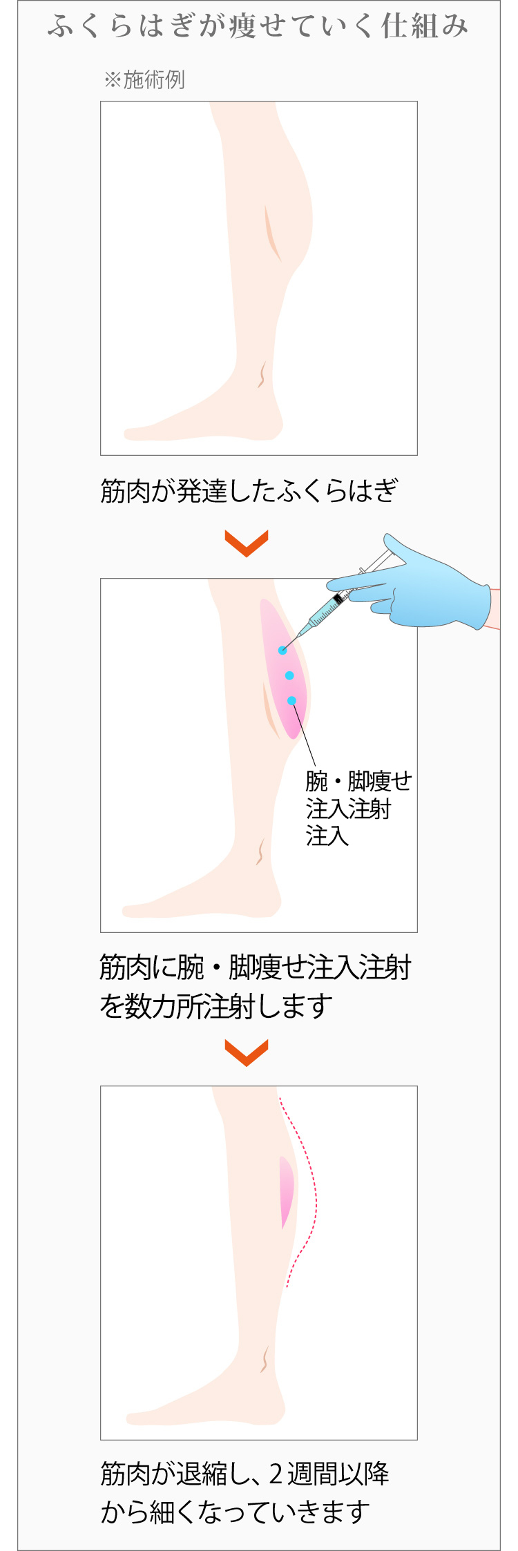 腕・脚痩せ注入注射でふくらはぎが細くなっていく仕組み