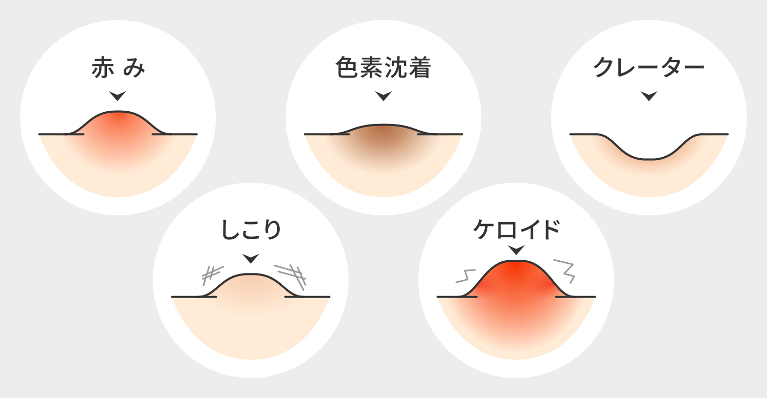 ニキビ跡の種類と原因