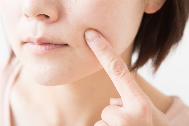 ダーマペンは元に戻る?繰り返し受けるメリットや効果を維持する工夫について解説