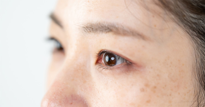 顔のシミを消す方法は？シミの種類や治療方法について解説