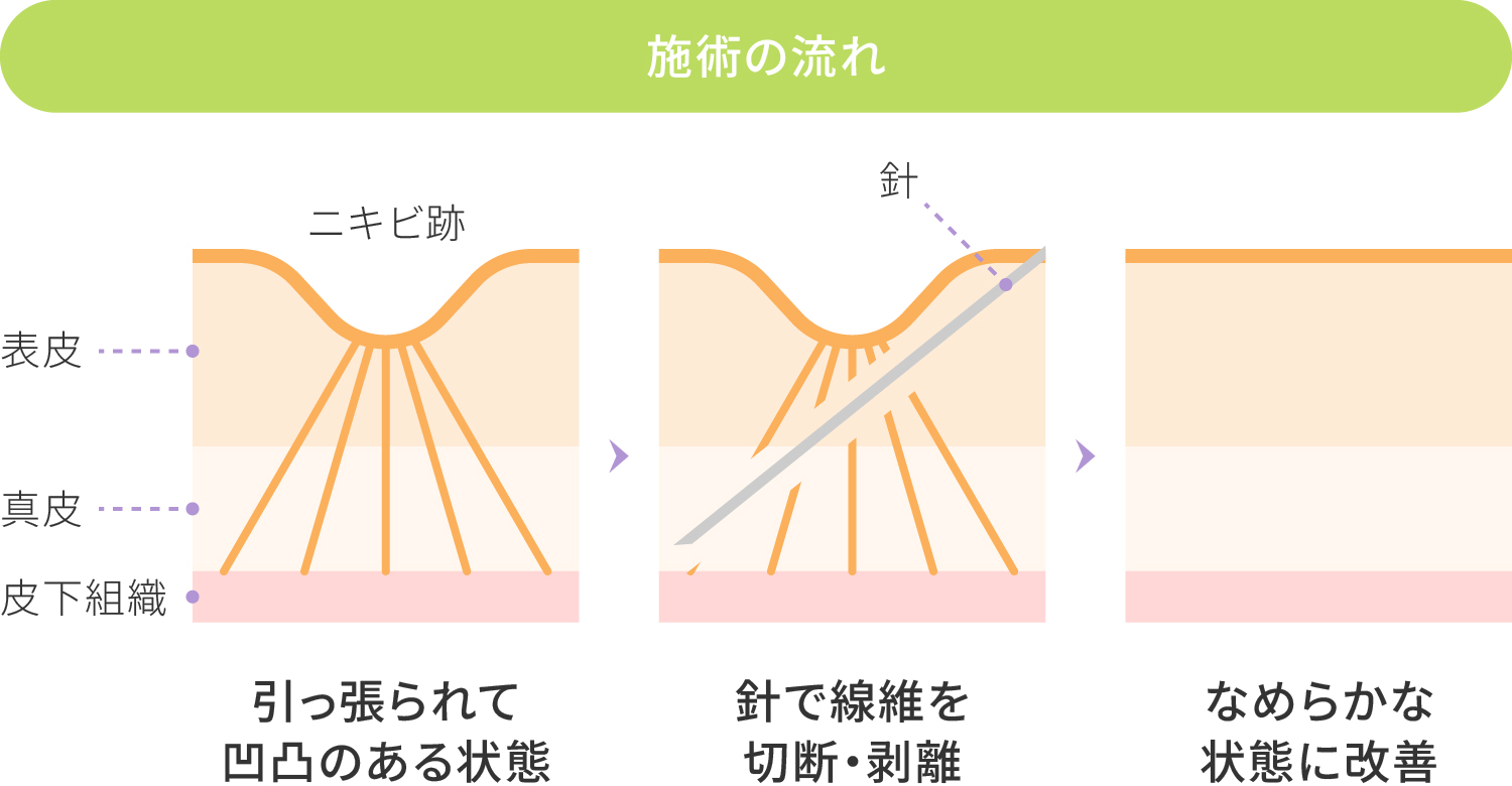 サブシジョンとは